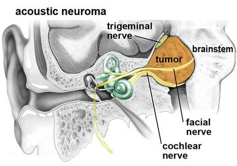 acoustic neuroma nerve